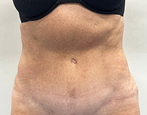 Tummy Tuck After